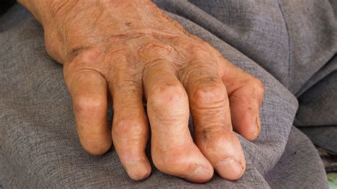 Leprosy