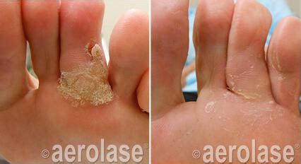 Before & After Wart Removal Procedures in Lubbock | Glo & Sparkle