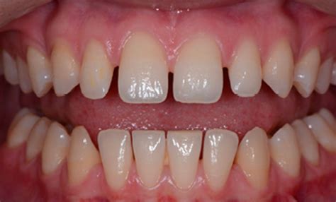 gaps  teeth treatment  thaltej ahmedabad braces gap treatment