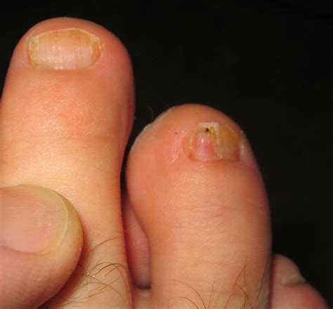 Types of toenail fungus - Awesome Nail