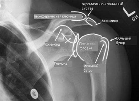 Рентген плечевого сустава: фото, показания и проведение
