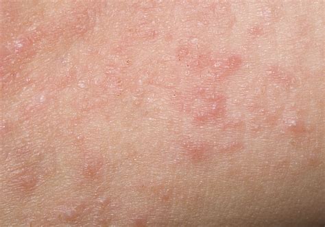 contact dermatitis overview