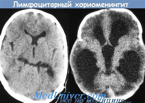 Серозные менингиты. Серозный лимфоцитарный хориоменингит - болезнь ...