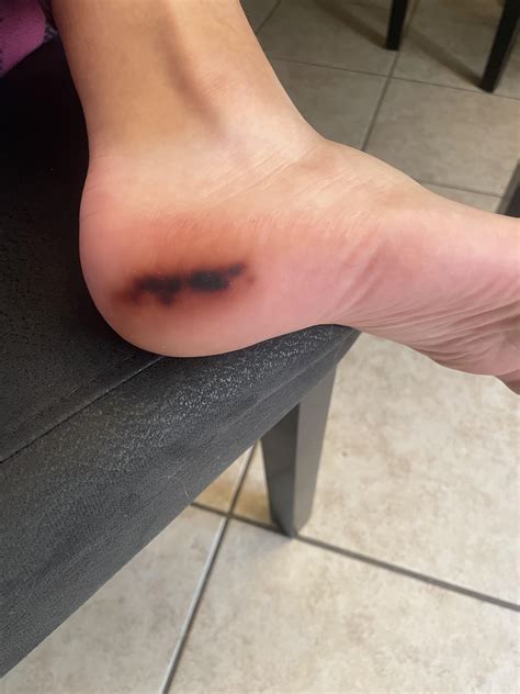 Hematoma? : r/bruises