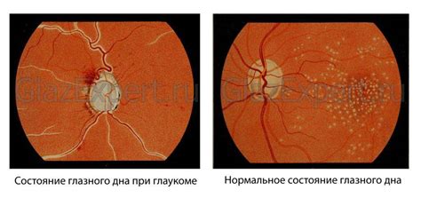 Закрытоугольная глаукома: причины, симптомы, лечение и профилактика