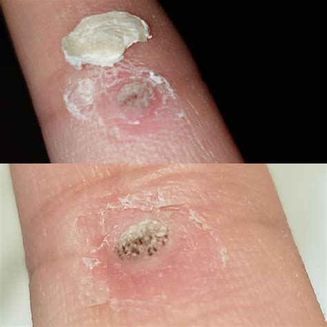 What To Expect During The Various Frozen Wart Stages As Your Skin Begins The Healing Process 1