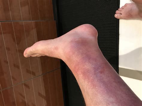 Hiker's rash: red rash between knee and ankle after hiking for several