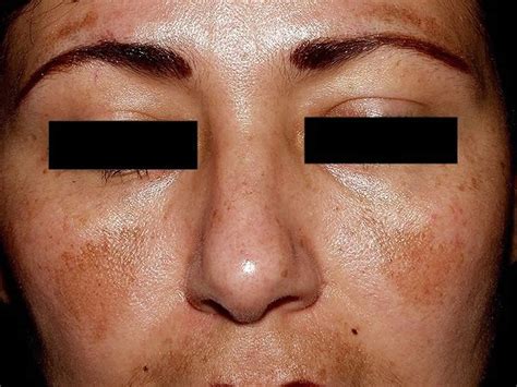 Melasma causes, symptoms, diagnosis & best treatment for melasma on face