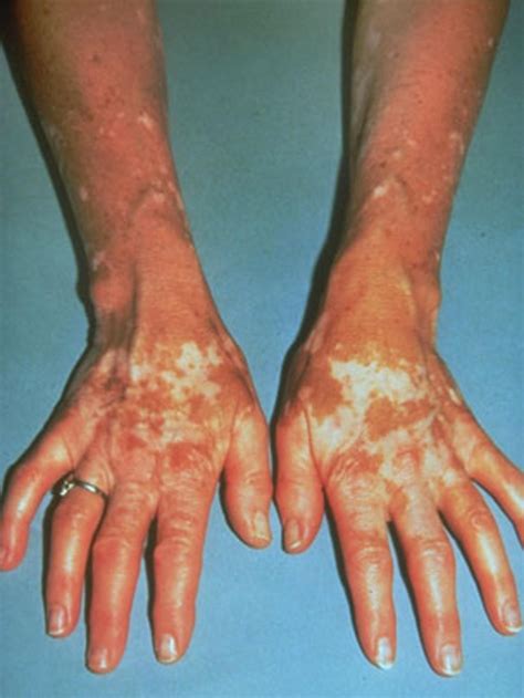 Vitiligo: Illustrated guide to pigmentation disorder