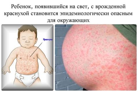 Краснуха: причины, симптомы, лечение, профилактика.