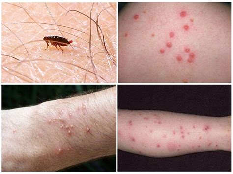 87 Awesome блоха человеческая укус - insectza