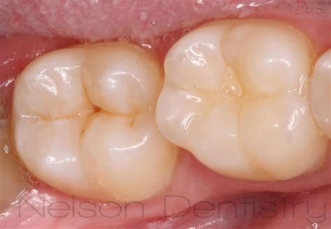 Early Cavity