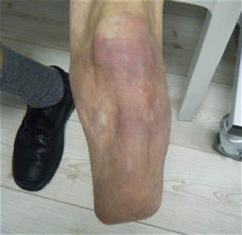 Leg Prostheses - Eugene Rossouw Prosthetics