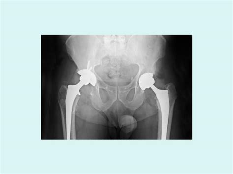 Coxarthrosis
