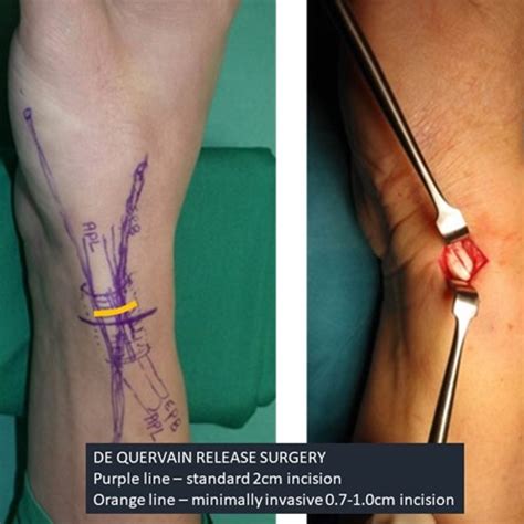 DeQuervain’s Tenosynovitis | Hand Surgery Associates