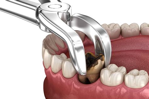 5 Diy Tooth Extractions That Require Brute Nerve