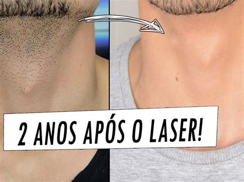 Depilação A Laser Da Virilha - Depilação Virilha Masculina Antes E Depois - Notícias e Entretenimento