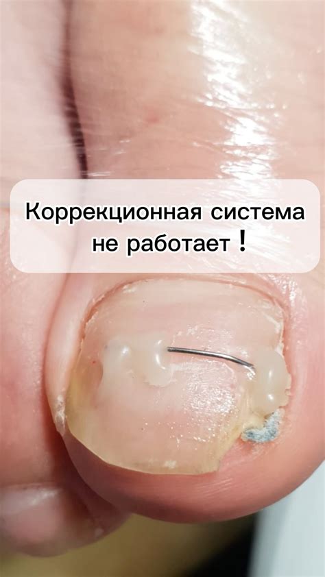 ОБУЧЕНИЕ•ПЕДИКЮР•ПОДОЛОГ•ВРОСШИЕ НОГТИ•МОСКВА (@podolog_tamilya ...