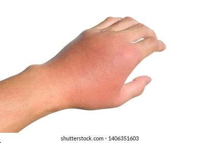 19,801 Cellulitis Royalty-Free Photos and Stock Images | Shutterstock