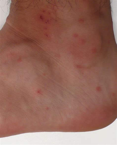 14 Common Bug Bite Pictures - How to ID Insect Bites and Stings