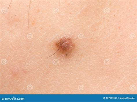 Mole On Men Skin Stock Photography | CartoonDealer.com #107056250