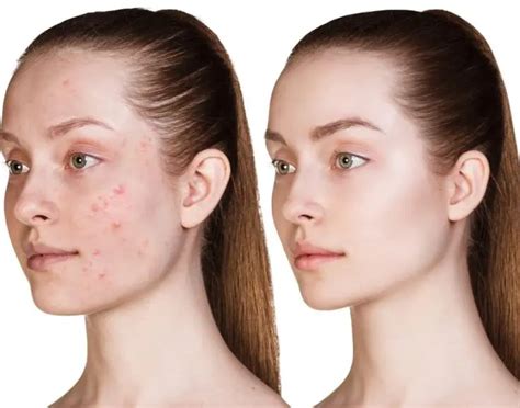 BBL Acne Treatment for Clear, Beautiful Skin | Daydreams Spa