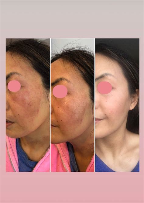 Why is my skin breaking out? — Diana Ralys Skin Health