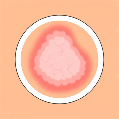 Premium Vector | Red and peach warts disease skin circle icon in flat style