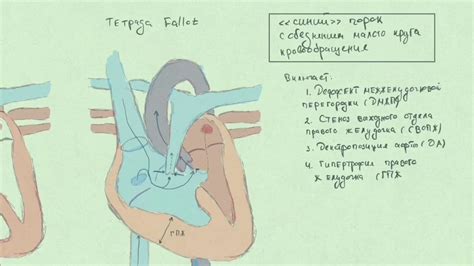 Тетрада Fallot (Фалло). Врожденные пороки сердца. - YouTube