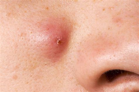 Cyst - Definition of Cyst