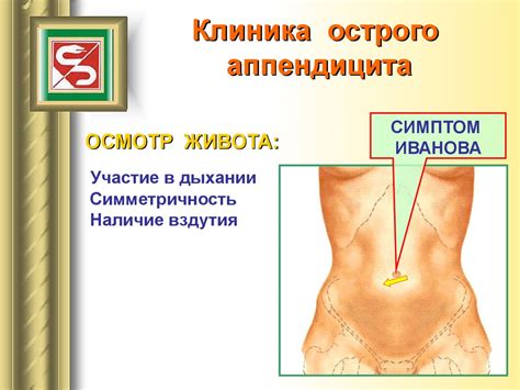 Острый аппендицит - презентация онлайн