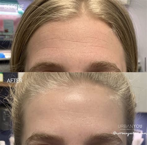 Botox Side Effects Forehead