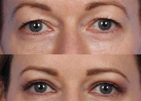 What is Hooded Eye Surgery? Your Definitive Guide to Blepharoplasty