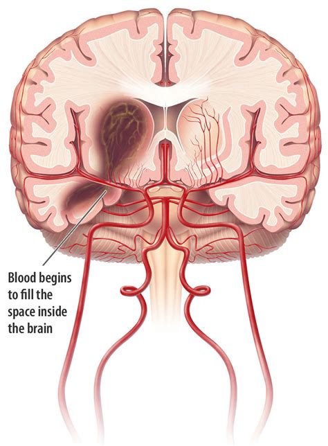 Intracranial Hemorrhage - Cause, Symptoms, Diagnosis, Treatment
