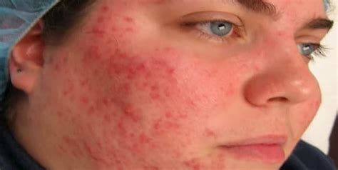 Viêm da Demodex : Nguyên nhân, triệu chứng, cách điều trị bệnh