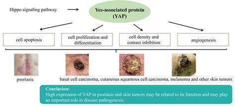Role of Yes-Associated Protein in Psoriasis and Skin Tumor Pathogenesis