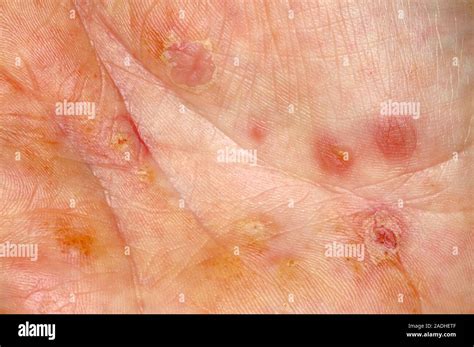 Eczema on a patient's palm. Eczema is an inflammation of the skin that ...