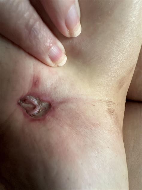 Help white belly button after tummy tuck : r/tummytucksurgery