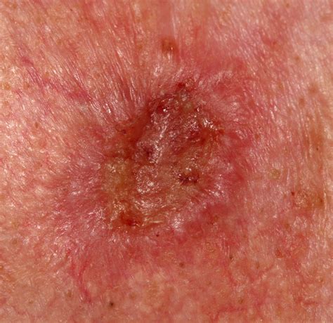 Skin Cancer White Spots | Images and Photos finder