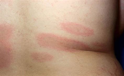 lyme disease rash  symptoms diagnosis  treatment