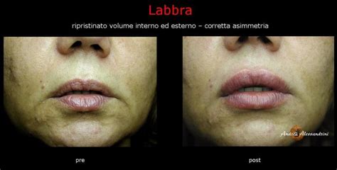 Labbra - Medicina Estetica Roma