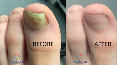 fungal nail infection in children treatment 5 home remedies for ...