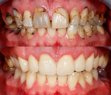 Dentinho Antes E Depois - Dentes Antes E Depois Do Tratamento Foto de Stock - Imagem de estética ...