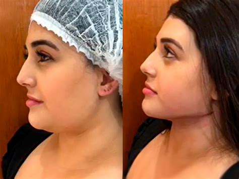 Lipo Da Papada Antes E Depois