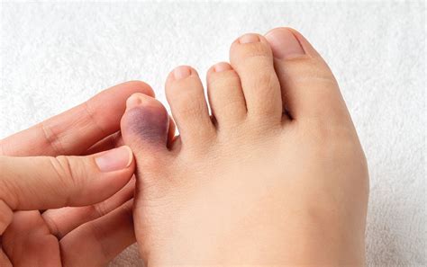 stubbed toe treatment      seek