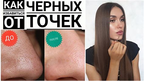 КАК Избавться От ЧЕРНЫХ ТОЧЕК | ДЕЙСТВЕННЫЕ СРЕДСТВА | Моя ИСТОРИЯ и ...