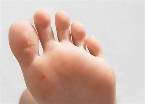 menyembuhkan mata ikan rintik sedu