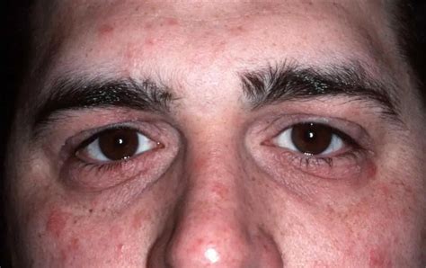 Increased prolactin in men: causes, symptoms, normal | Men's he alth