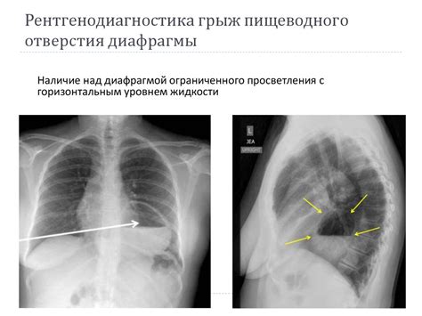 Рефлюкс-эзофагит. Грыжи диафрагмального отверстия пищевода ...