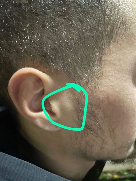 Warum habe ich eine beule am ohr? (Gesundheit und Medizin, Gesundheit
